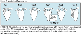 acl injury types pics.gif