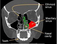 hd-ct-sinus.jpg